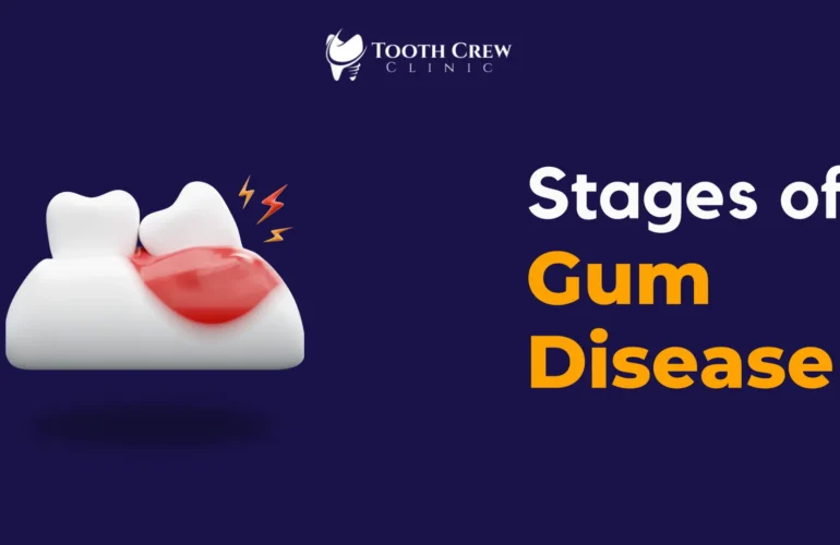 Gum Diseases banner