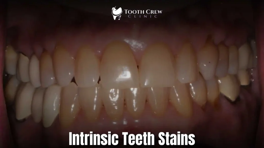 picture showing intrinsic teeth stains