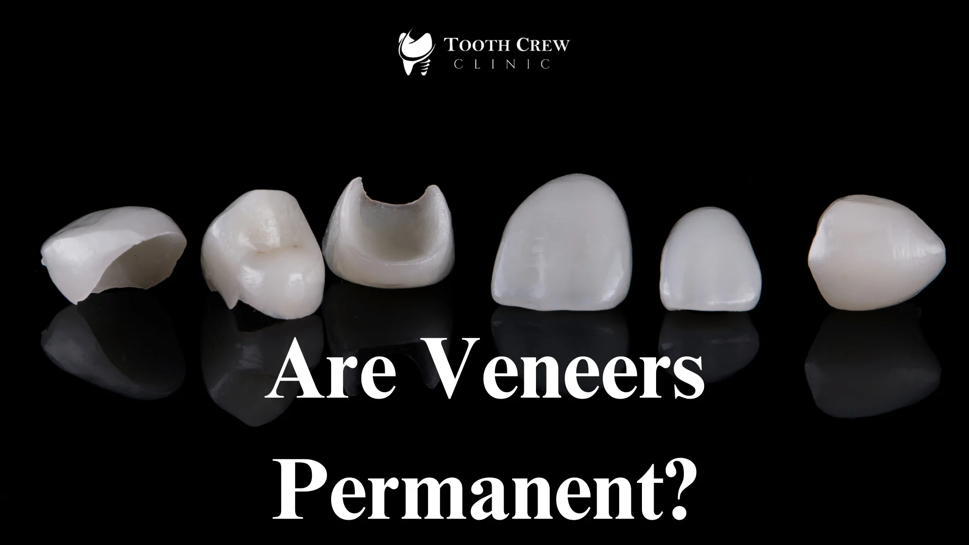 Are Veneers Permanent?