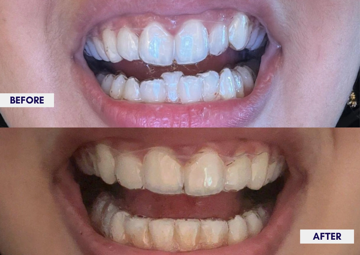 Aligners Case