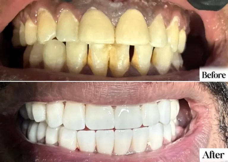 Before and after a smile makeover: yellowed, gapped teeth restored to an even, white smile