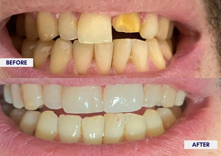 Before and after veneers: a stained and broken front tooth restored with veneers