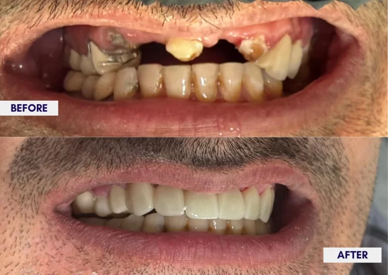 Before and after a zirconia bridge replacing broken and missing front teeth
