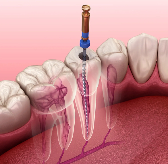 AI illustration of root canal