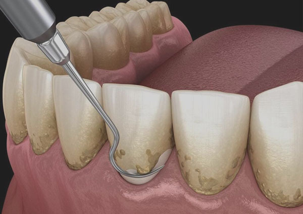 illustration showing teeth scaling, removing tartar