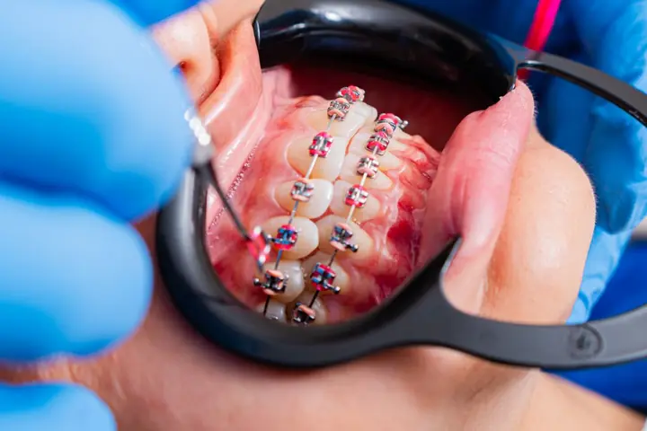 Close-up of metal braces being checked by a dentist