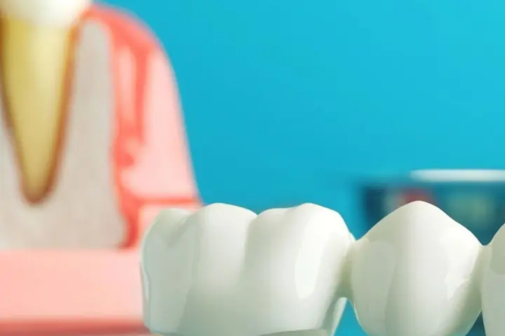 Porcelain dental crowns next to a tooth model