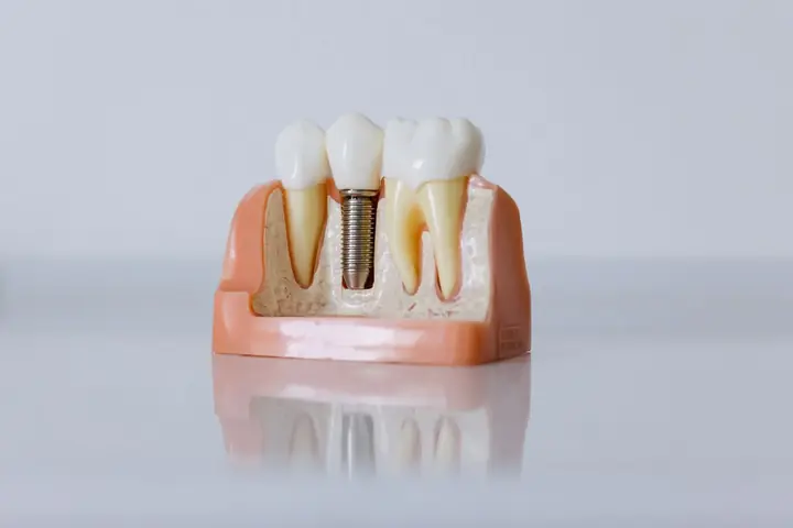 Dental implant model showing a titanium implant between natural teeth