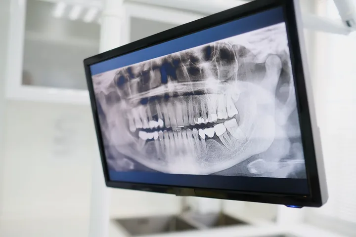 Panoramic OPG dental X-ray shown on a monitor