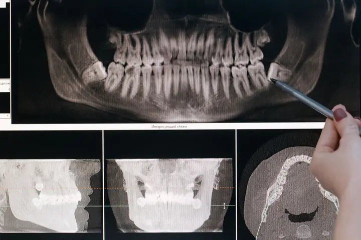 Dental X-ray being examined before root canal treatment